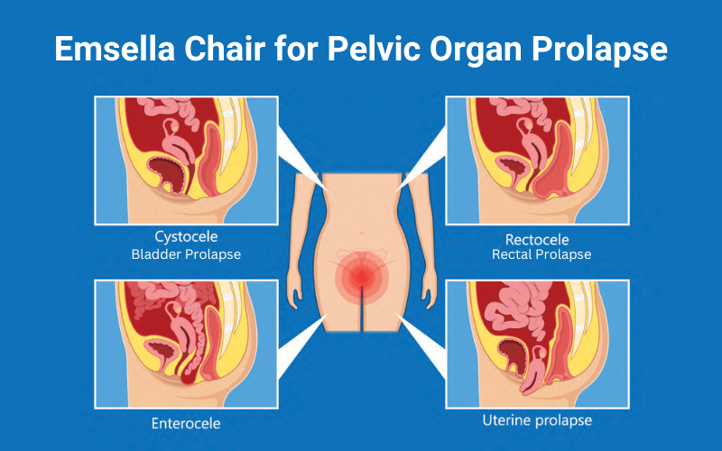 Does Emsella Work for Prolapse